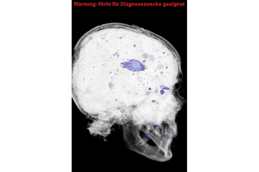 Das ist eine andere Aufnahme desselben Schädels. Der Schädel wurde nachträglich mit Erde gefüllt, sodass man auf der Aufnahme neben der Bleikugel auch kleine röntgendichte Steine erkennen kann. Die Metallgeschosse sind immer gut zu erkennen. Das war auch der Wunsch der Archäologen: Dass wir diese Geschosse in den Schädeln nachweisen können, ohne den Schädel zu beschädigen.