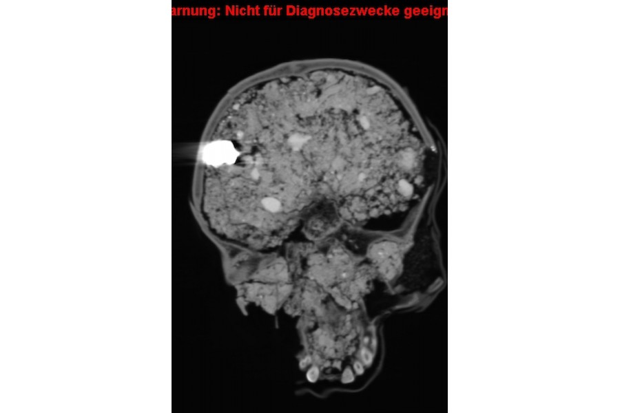 Auf der rechten Seite des Bildes sieht man ein etwa drei Zentimeter großes Einschussloch im Schädel. Das ist die schwarze Stelle, an der eine Lücke im Knochen zu sehen ist. Auf der anderen Seite, im Inneren des Schädels ist die Bleikugel zu sehen, die im Vergleich zum Rest keine Röntgenstrahlen durchlässt und deshalb sehr hell ist. Man kann also erkennen, dass die Kugel auf der einen Seite in den Schädel eingedrungen, aber auf der anderen Seite nicht ausgetreten ist.